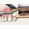 GDC Sinus Lifting