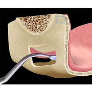 GDC Sinus Lifting