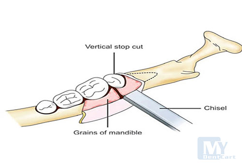 GDC BONE CHISEL CG1