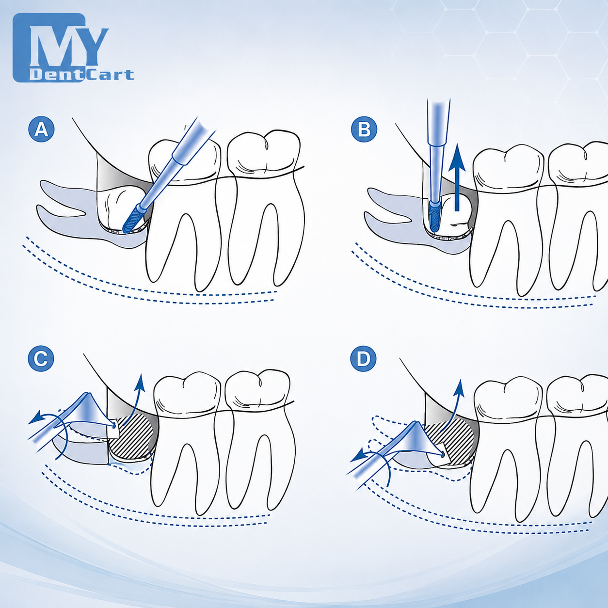 GDC Oral Surgery Impaction Kit set of 22 Pcs